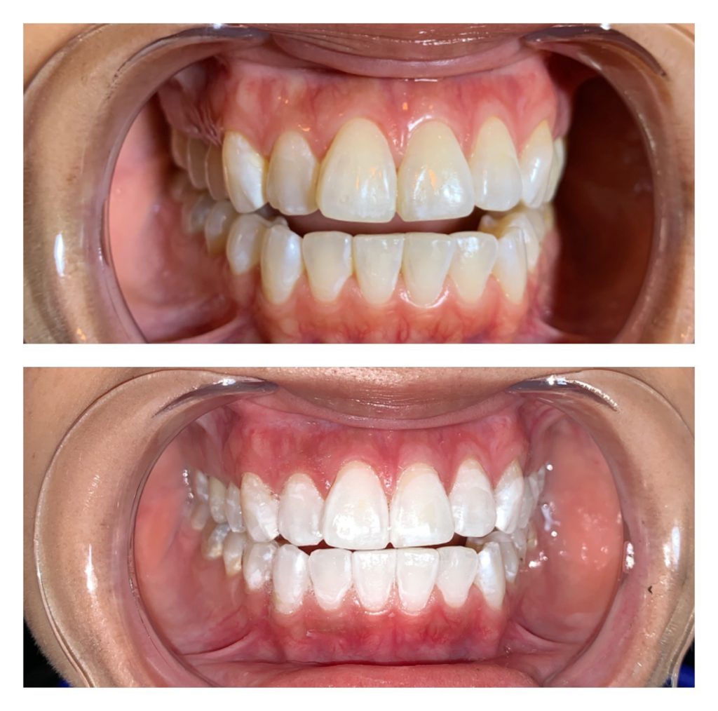 The Rx Beauty Studio Troy New York Teeth Whitening