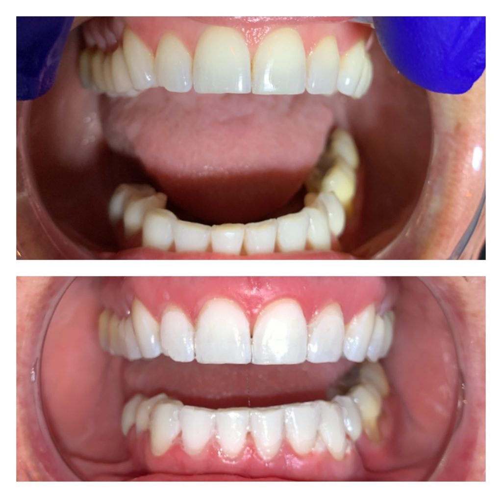 The Rx Beauty Studio Troy New York Teeth Whitening