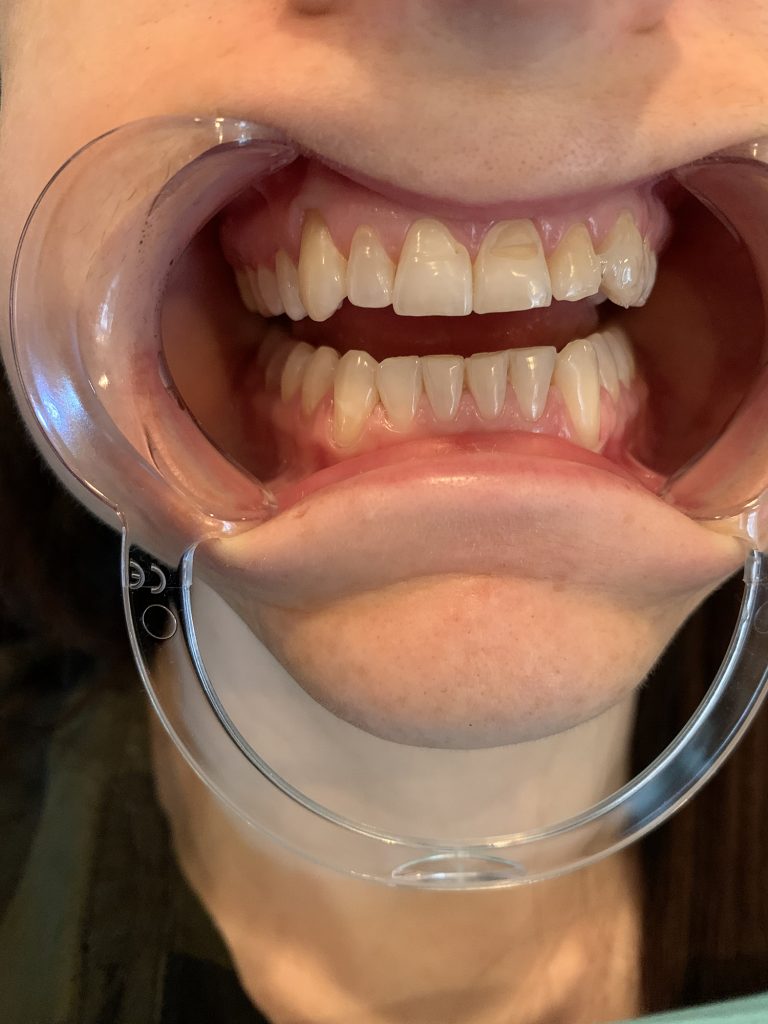 The Rx Beauty Studio Troy New York Teeth Whitening