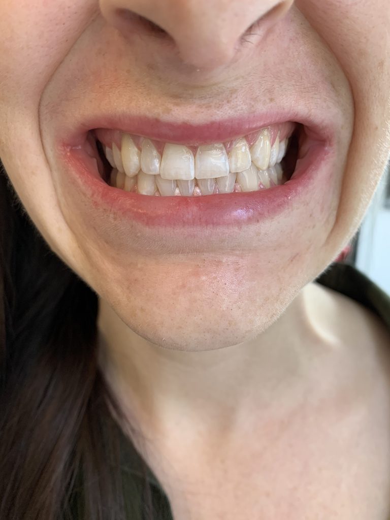 The Rx Beauty Studio Troy New York Teeth Whitening