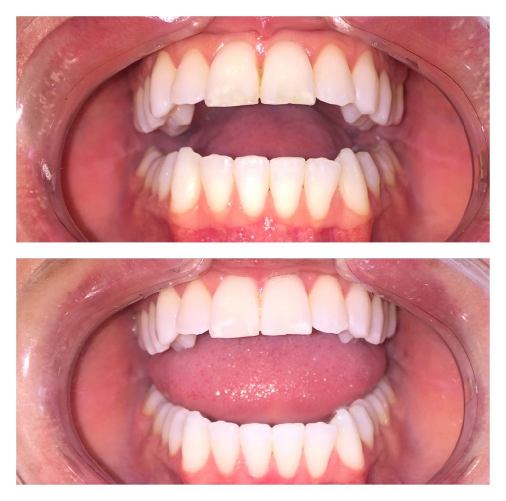 The Rx Beauty Studio Troy New York Teeth Whitening