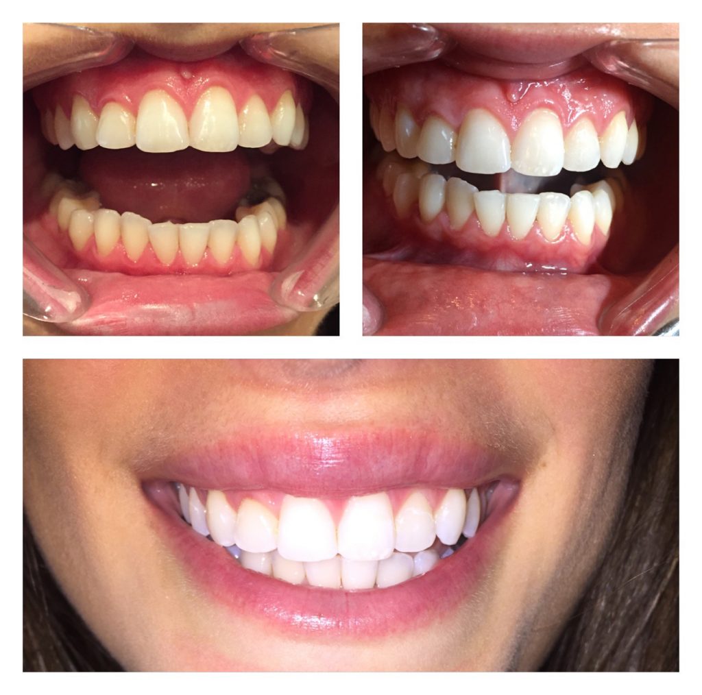 The Rx Beauty Studio Troy New York Teeth Whitening