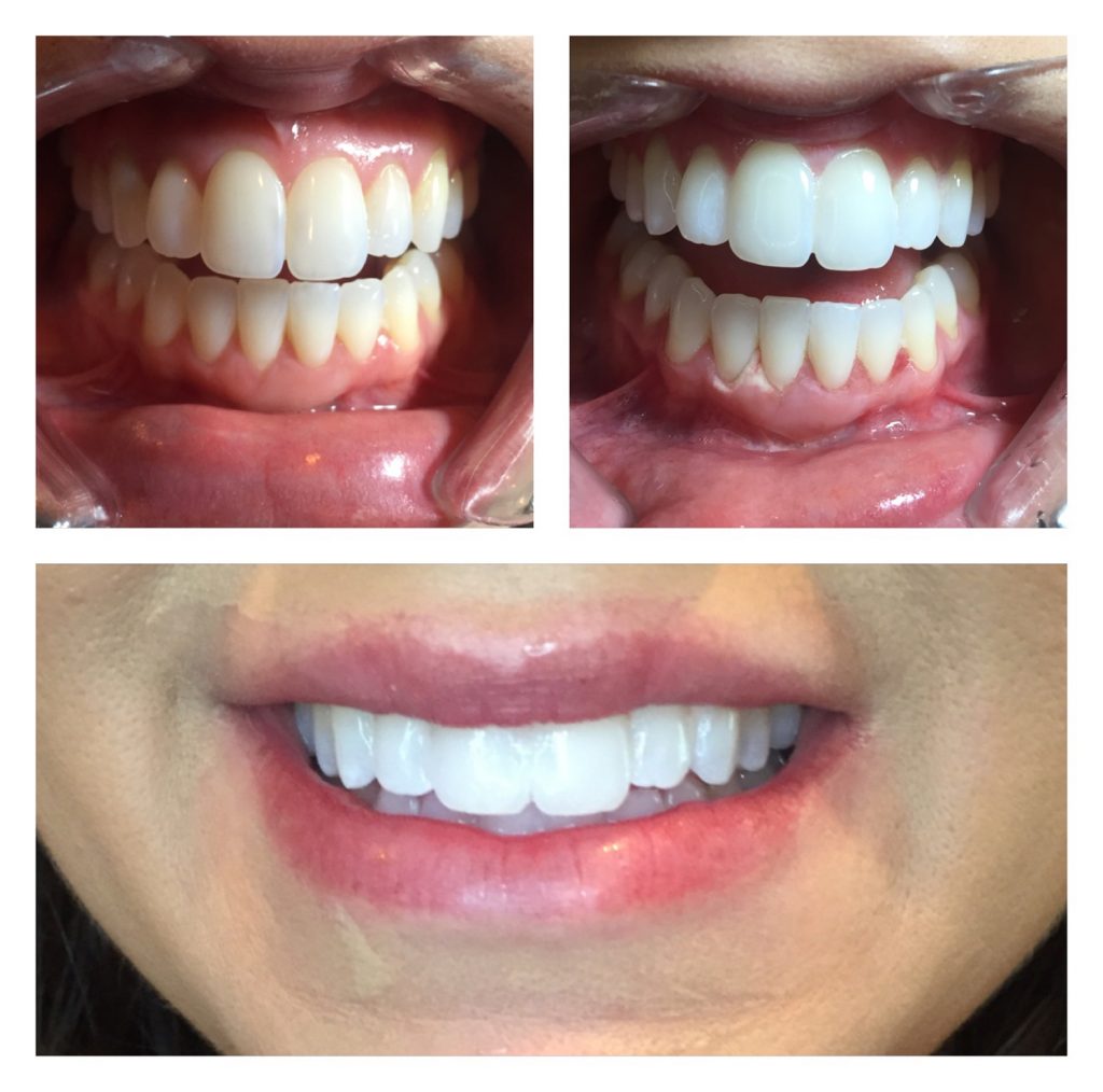 The Rx Beauty Studio Troy New York Teeth Whitening