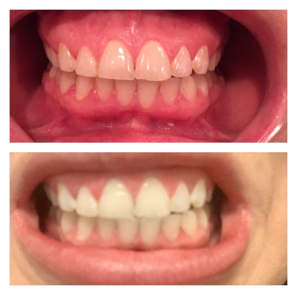 The Rx Beauty Studio Troy New York Teeth Whitening