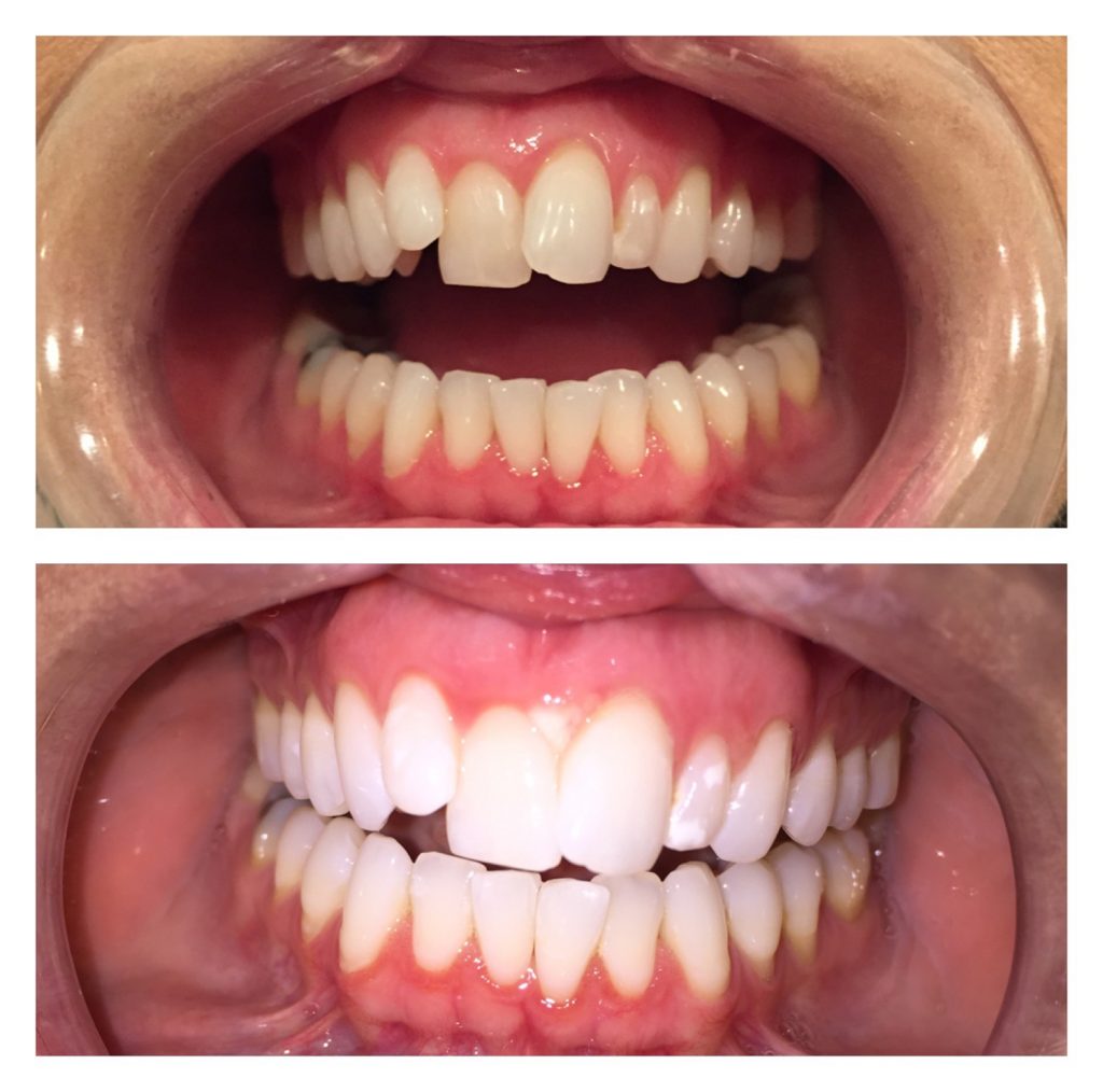 The Rx Beauty Studio Troy New York Teeth Whitening