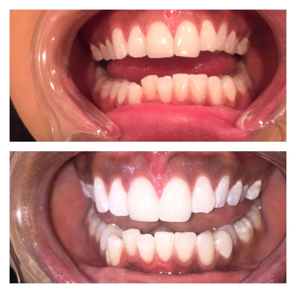 The Rx Beauty Studio Troy New York Teeth Whitening