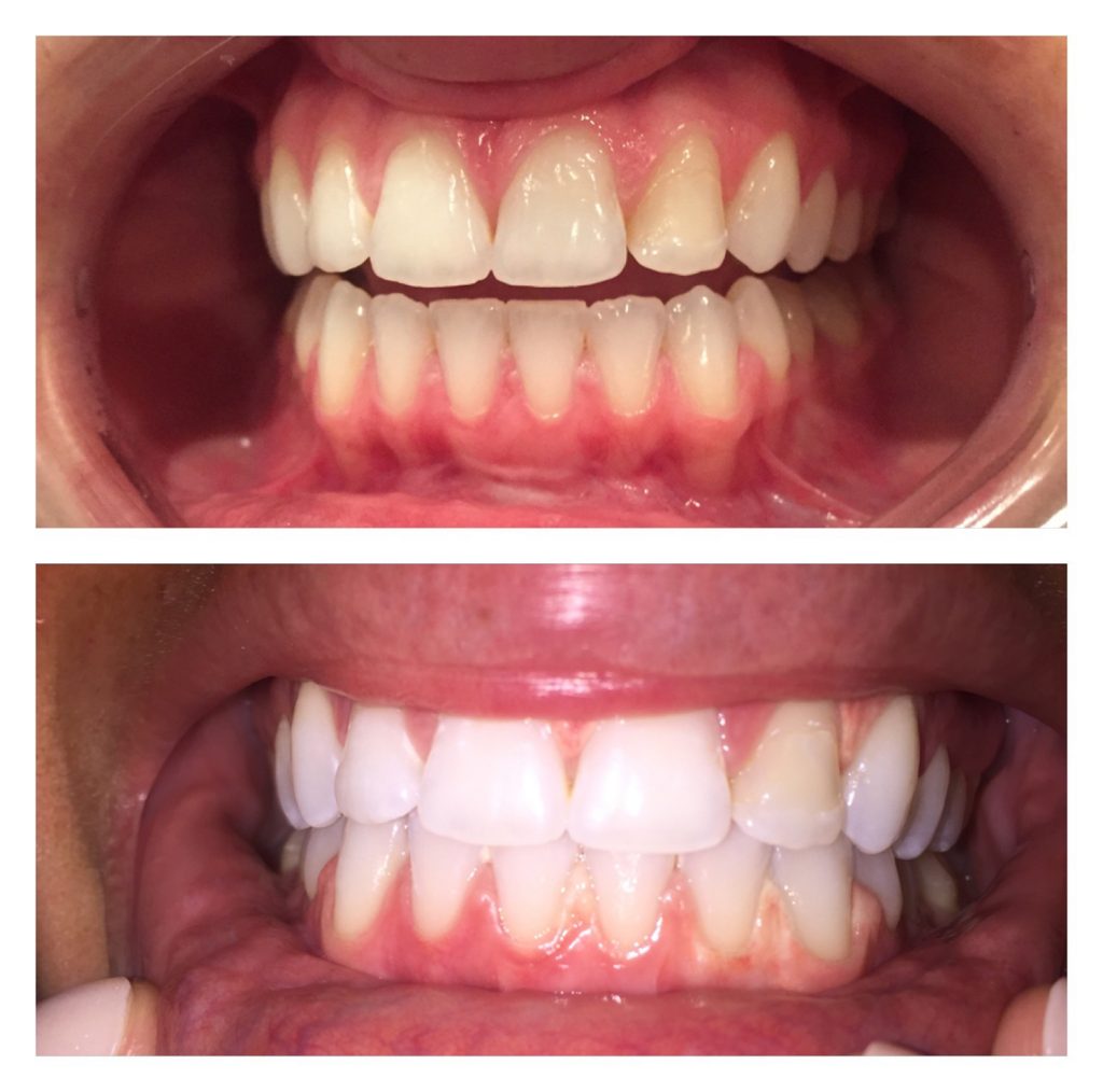 The Rx Beauty Studio Troy New York Teeth Whitening